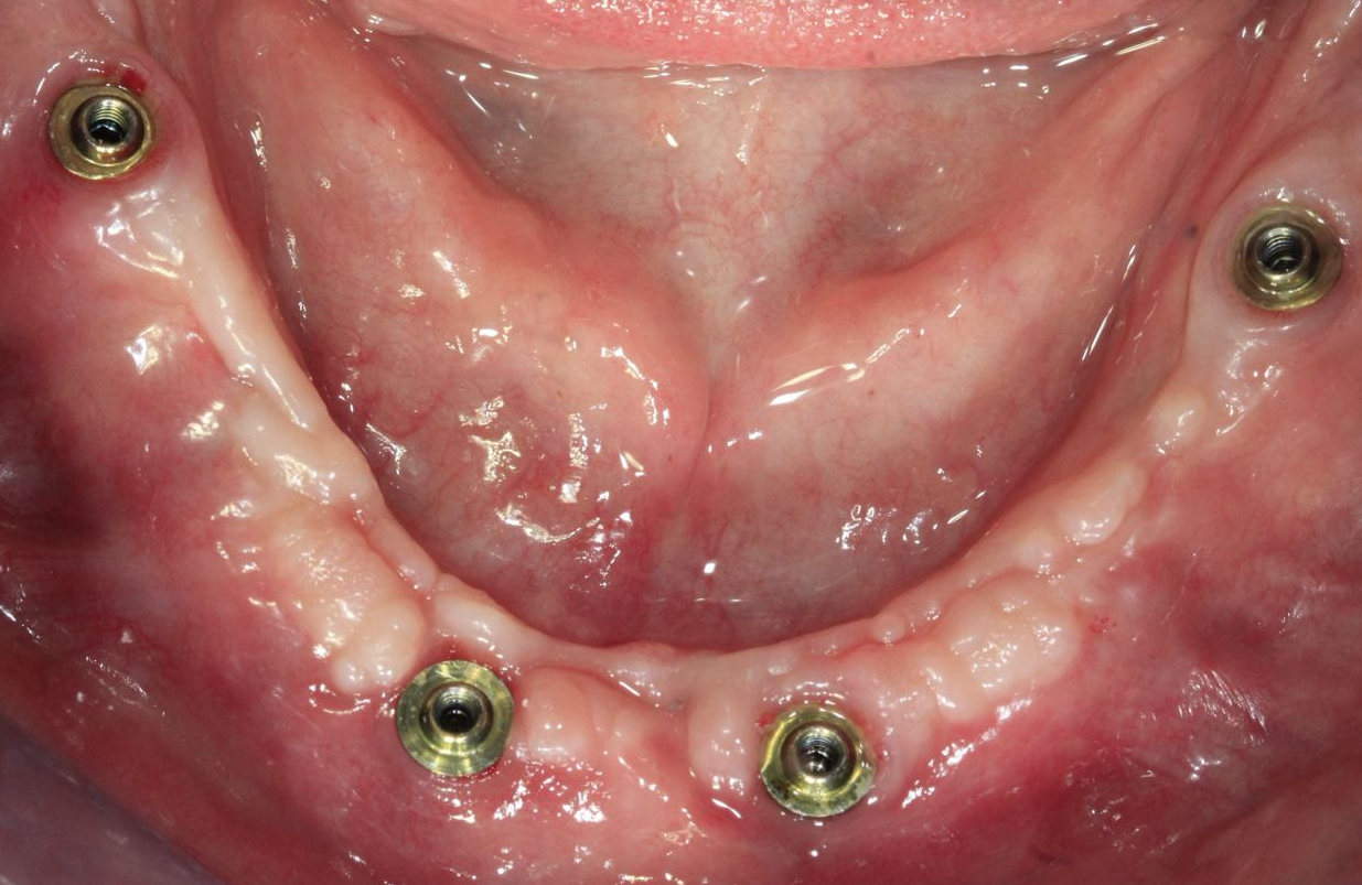 Intraoral view of four multi-unit abutments on a healed mandibular arch, prepared for a final impression.