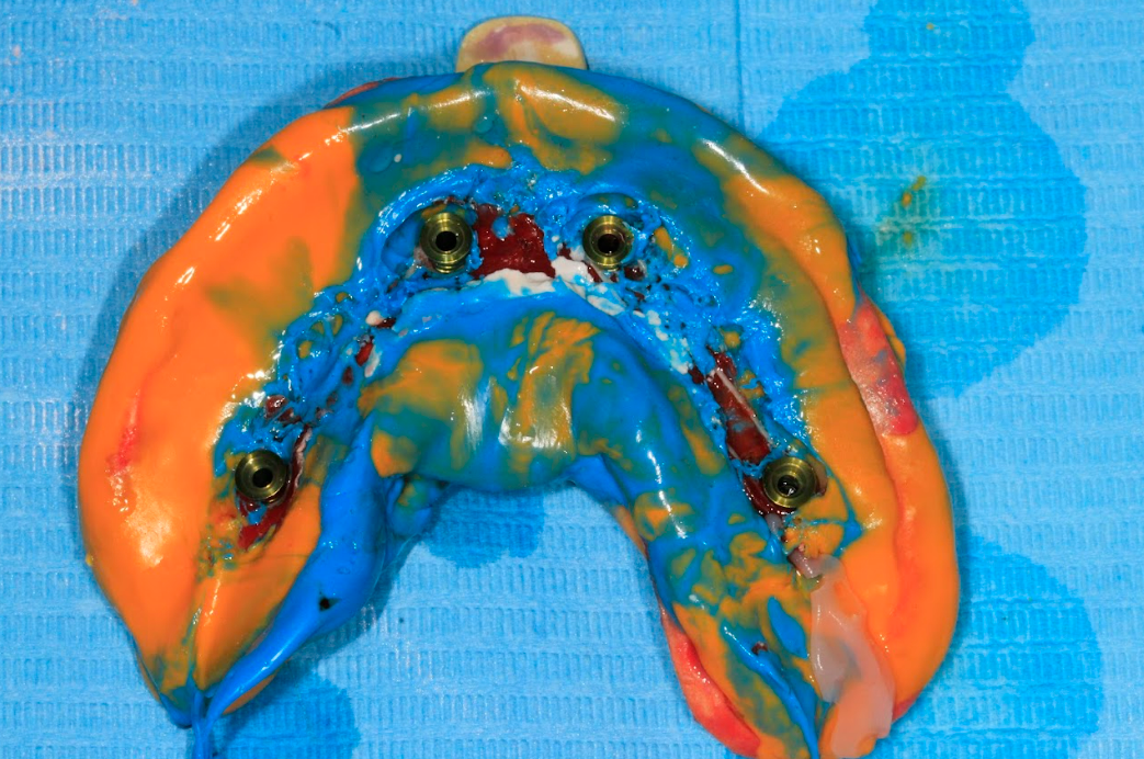 A photo of the final, accurate impression of the mandibular implants and soft tissue, which will be used to fabricate the prosthesis.