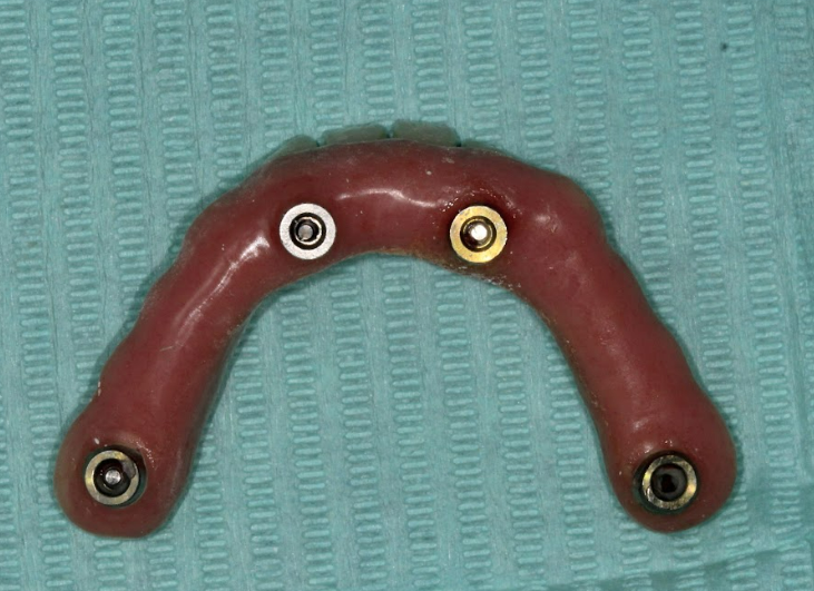 A view of the inner surface of the final bar-supported prosthesis, showing the attachments that connect to the multi-unit abutments.