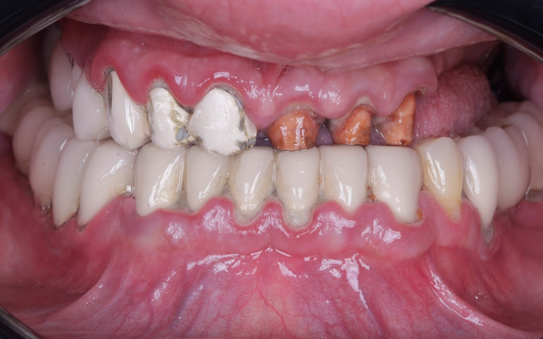 Intraoral frontal photograph showing remaining natural teeth in anterior region and prepared abutment teeth in posterior areas after removal of failed restorations in 49-year-old male patient