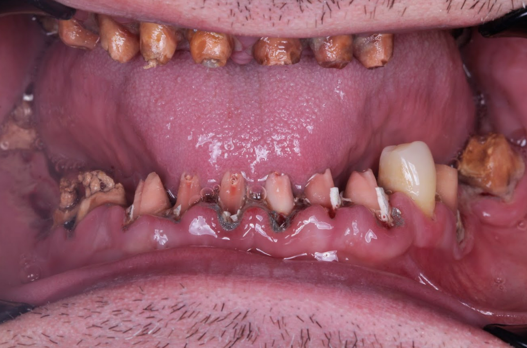 Occlusal view of upper dental arch displaying prepared abutment teeth, compromised tooth structures, and edentulous spaces requiring fixed screw-retained prosthetic rehabilitation