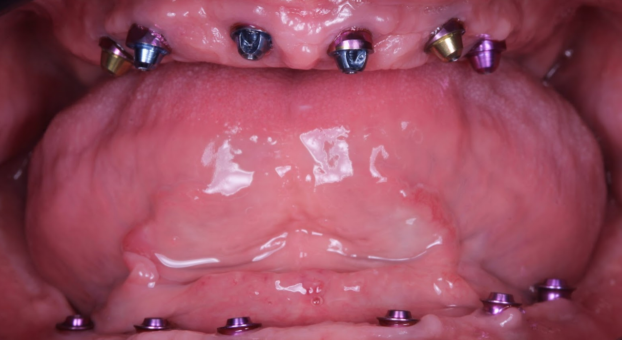Occlusal view of maxillary arch showing six Neobiotech IS-II Active implants with D-Type XGATE multi-unit abutments placed after osseointegration, with localized bone augmentation using InterOss osteoplastic material