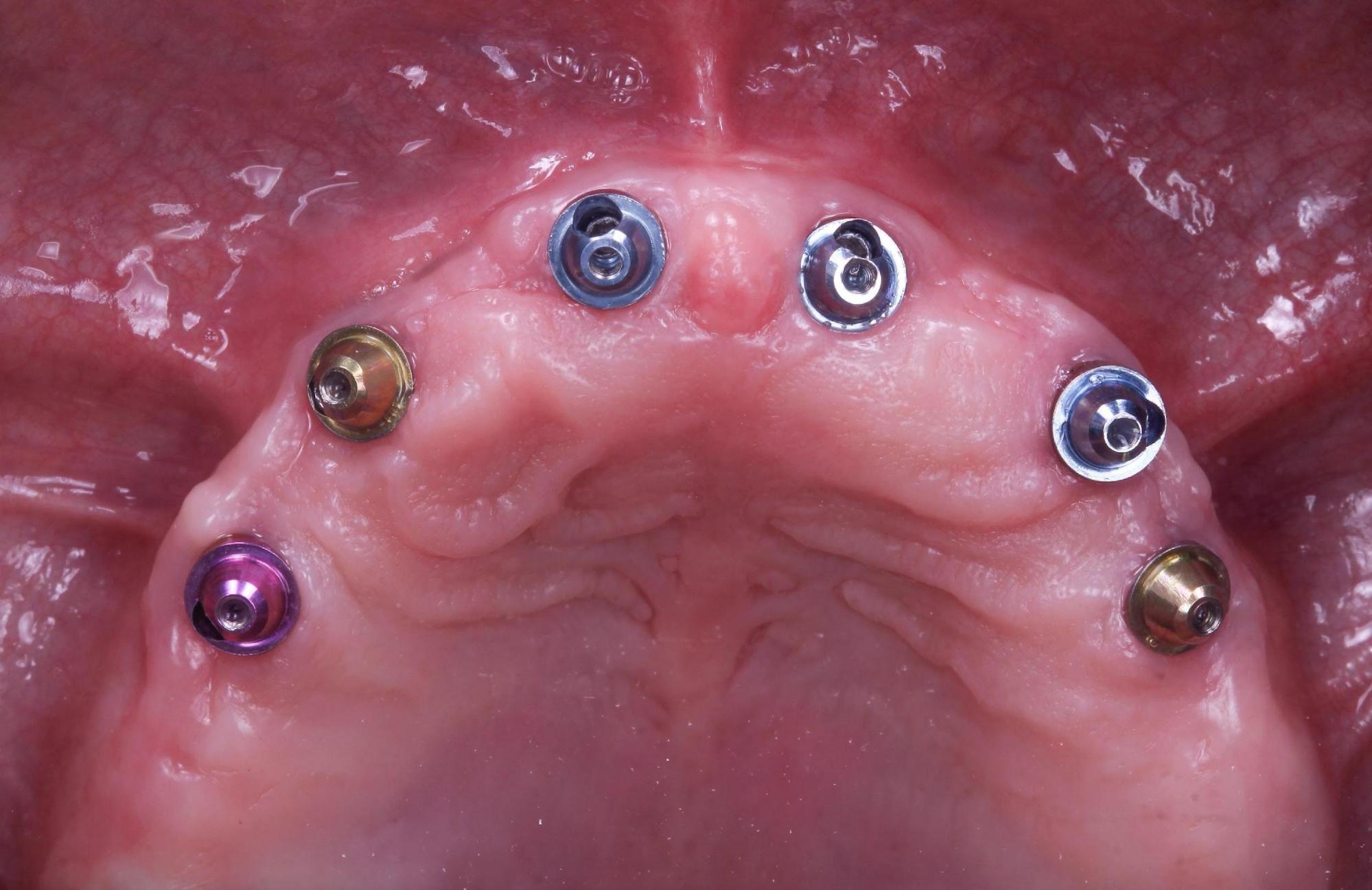 Occlusal view of mandibular arch displaying six Neobiotech IS-II Active implants with V-Type XGATE multi-unit abutments positioned for screw-retained prosthetic rehabilitation following healing period