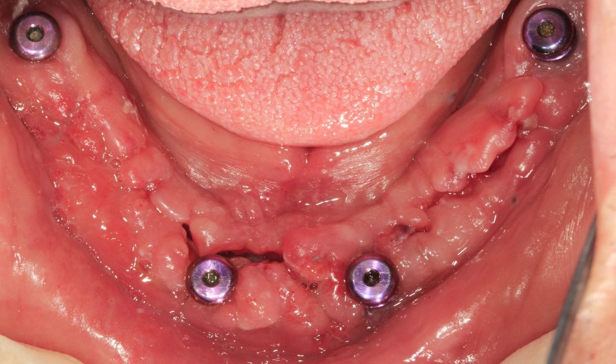 Four dental implants in the lower jaw with completely healed gums before the final teeth are placed.