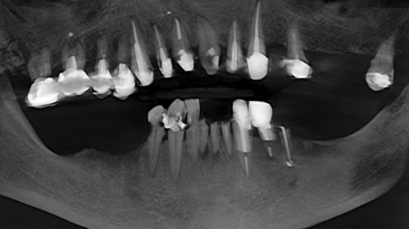 A panoramic X-ray showing the initial complex dental condition of a 72-year-old male patient, with multiple failing teeth in both jaws.