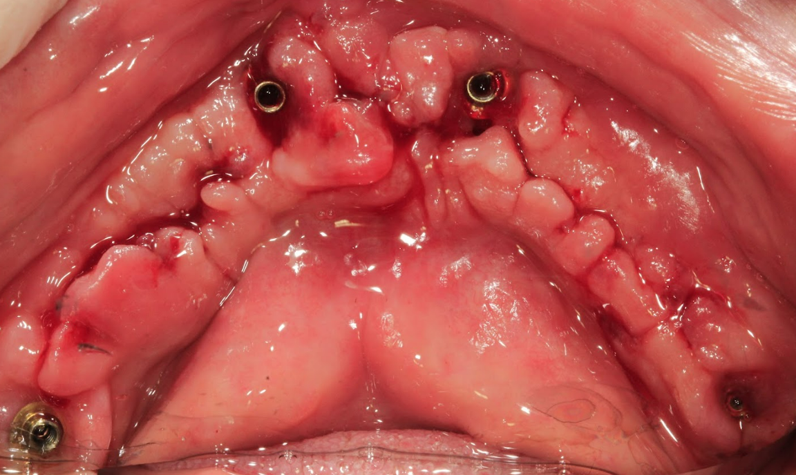 An intraoral photo showing the healthy, healed soft tissues of the mandible before the final prosthesis is delivered.