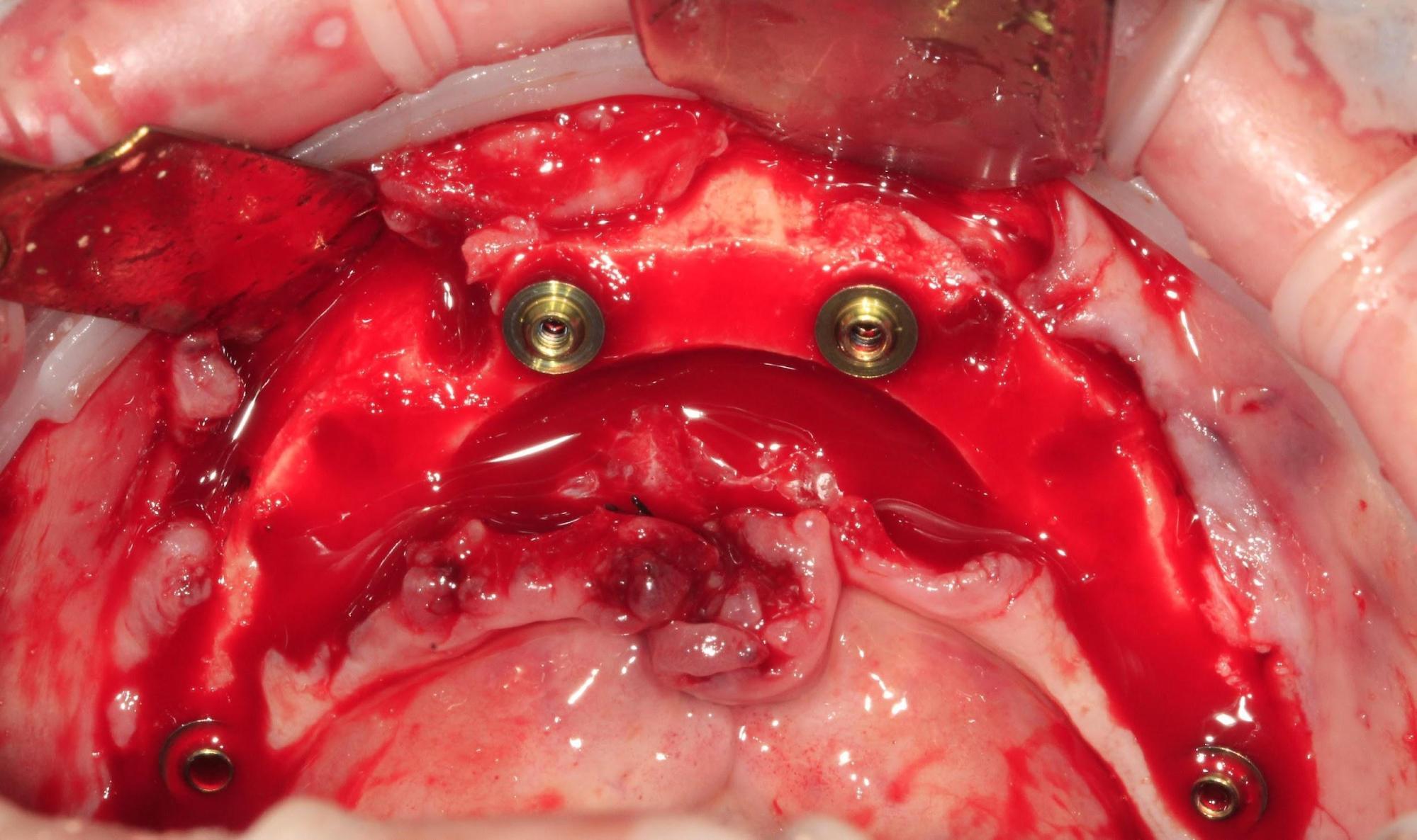 A clinical photo showing four straight V-type multi-unit abutments immediately seated on the newly placed dental implants in the mandible.