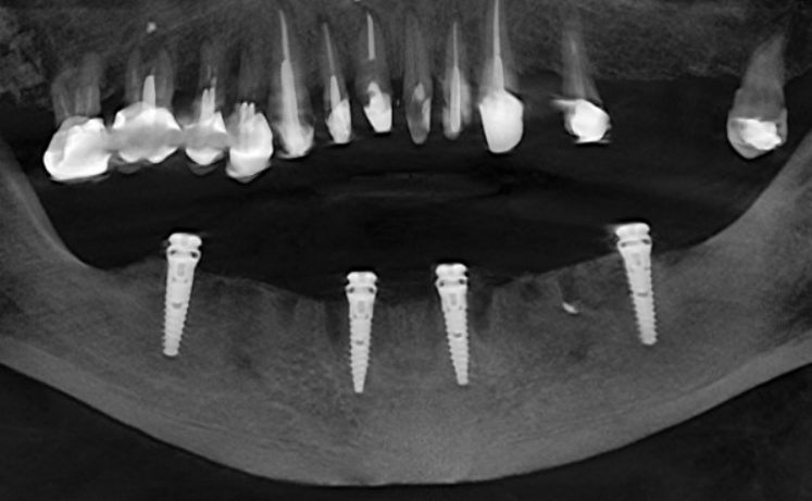 A post-operative panoramic X-ray showing the final position of the four dental implants placed in the mandible for a full-arch restoration.