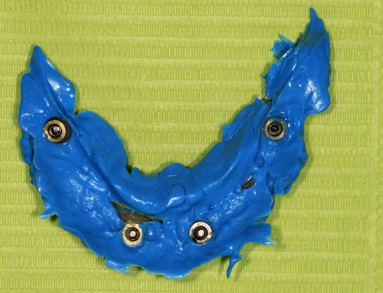 A photo showing the underside of the prosthesis filled with blue impression material, creating a new model of the healed soft tissues for the reline.