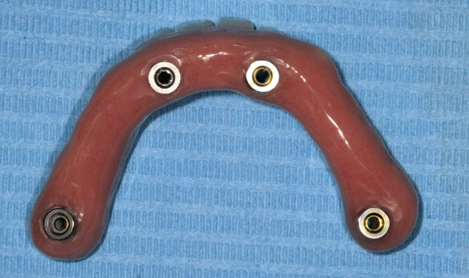 The inner surface of the mandibular prosthesis after the laboratory reline procedure, now perfectly adapted to the healed gum contours.