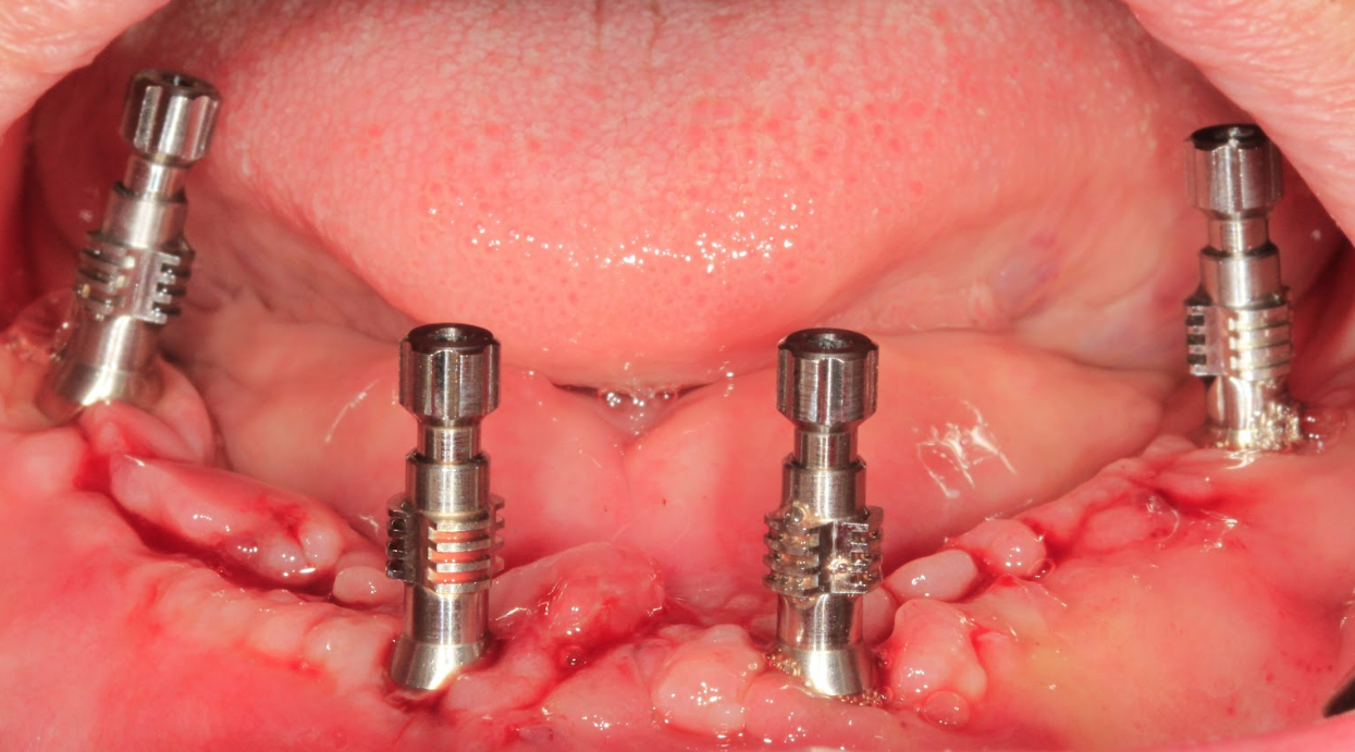 A clinical photo showing standard-type impression transfers placed on the multi-unit abutments for a new, more accurate plaster impression.