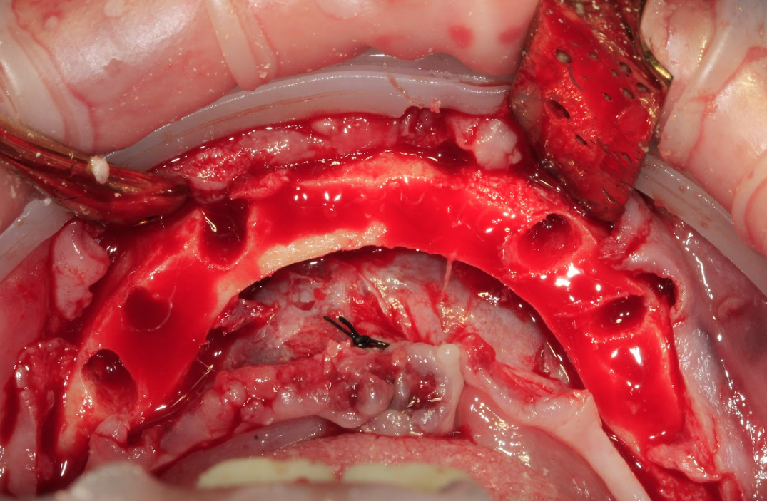 A clinical photo of the mandibular surgical site after extractions and alveolar crest reduction (osteoplasty) have been performed.