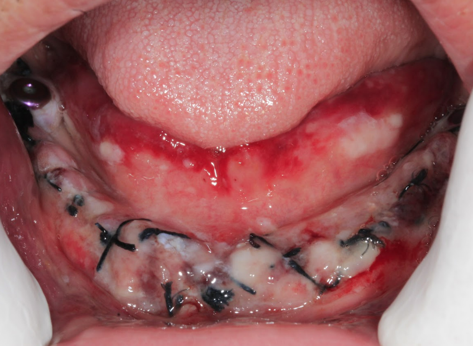 A clinical photo of the patient's mandible showing the sutured surgical site and initial healing 8 hours after the operation.