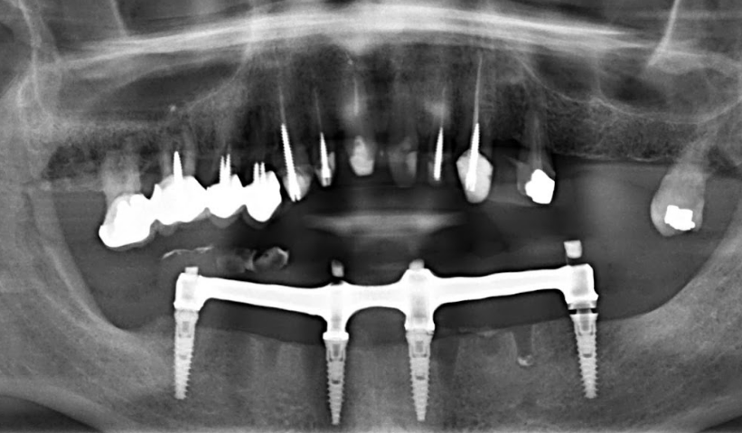 A panoramic X-ray showing the new, corrected titanium bar seated on the implants with a perfect, passive fit.