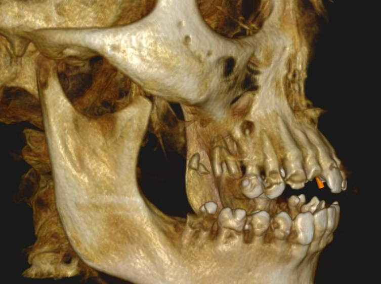 Lateral right view of the 3D virtual model detailing the remaining dentition and bone structure.