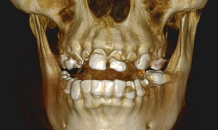 3D virtual model of the patient's maxilla and mandible showing extensive bone volume loss in the upper jaw.