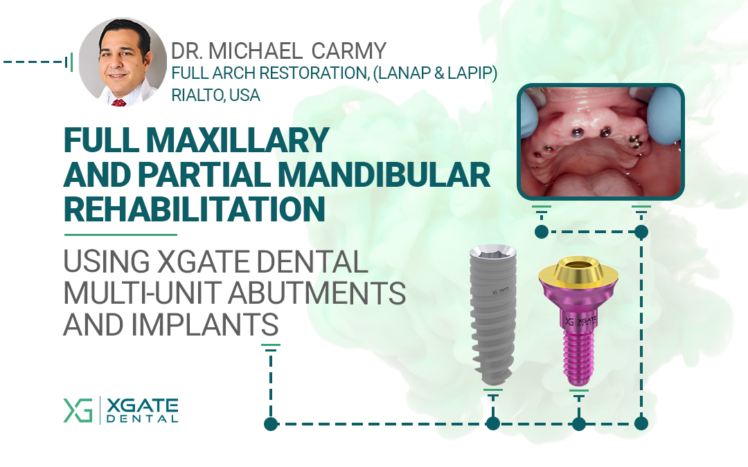 Full Maxillary and Partial Mandibular Rehabilitation Using XGATE Dental Multi-Unit Abutments and Implants