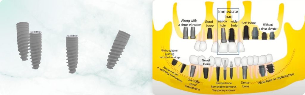 Thread, Taper, and Reverse Taper: How Implant Shape Determines Its Application. Part 1