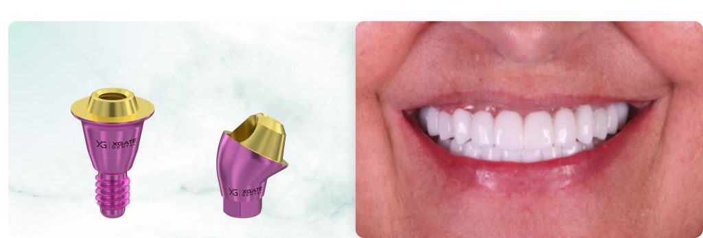 Complete Maxillary Rehabilitation on 8 Implants Using a Combination of XGATE Dental D-Type and V-Type Multi-Unit Abutments