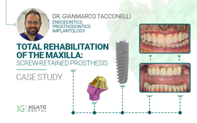 Total Rehabilitation of the Maxilla: a Screw-Retained Prosthesis Using Implants and MUAs by the German Brand XGATE