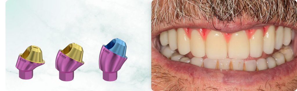 Total Rehabilitation of the Maxilla: a Screw-Retained Prosthesis Using Implants and MUAs by the German Brand XGATE