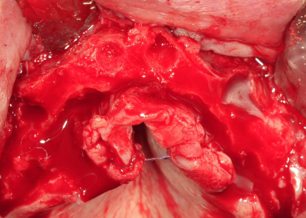 Surgical procedure of alveoloplasty in the anterior maxilla to create vertical space for the prosthesis.