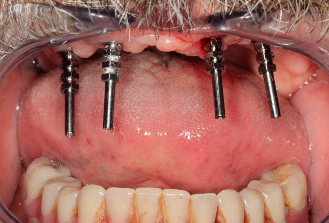Final impression taken using MUA-level impression copings on all four osseointegrated implants.