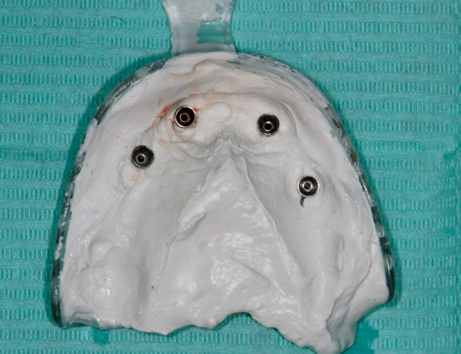 The final impression tray showing the captured positions of the four multi-unit abutments.