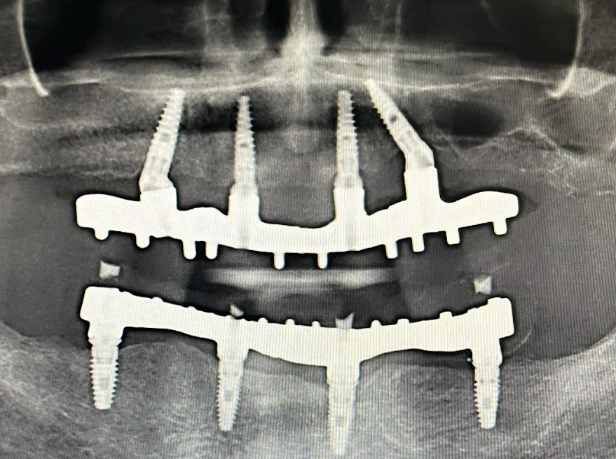 Final radiograph (OPG) confirming the passive fit of the final prosthesis framework on all four implants.