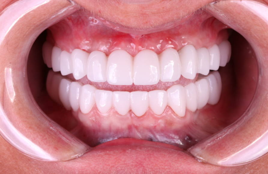 Intraoral view with retractors showing the final permanent zirconia bridge seated on 8 maxillary implants without artificial gingiva.