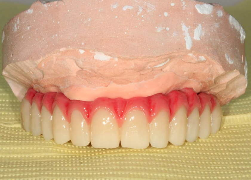 The final milled PMMA prosthesis with layered composite pink gingiva on the master cast.
