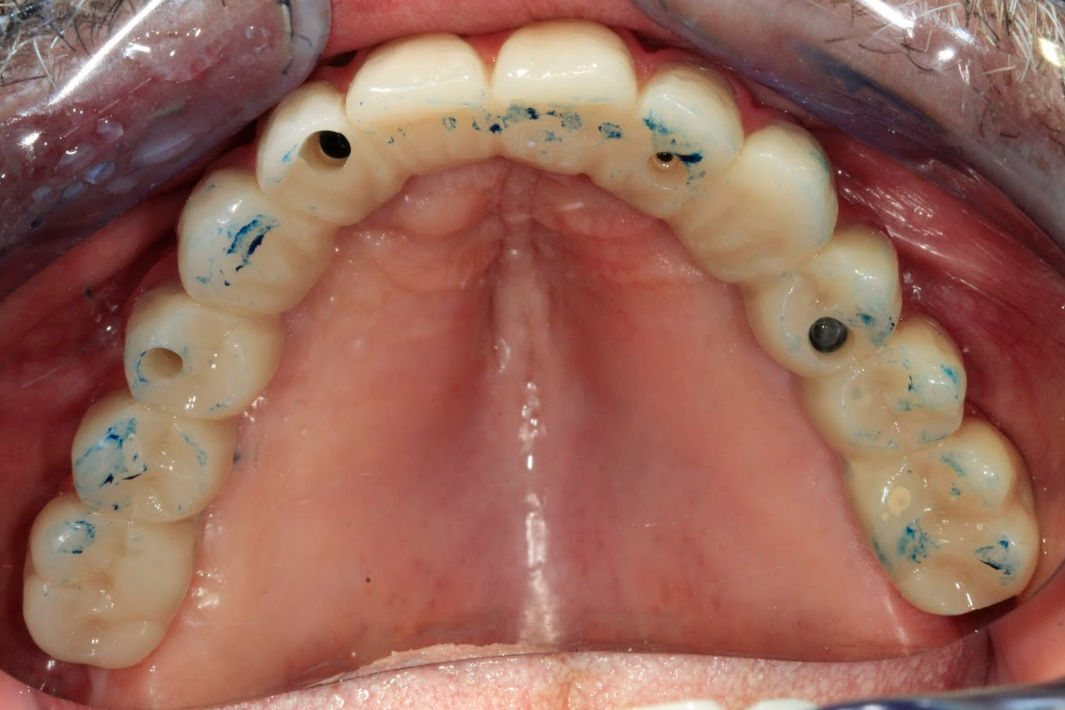 Occlusal view of the delivered final prosthesis during the occlusion check, showing articulation marks.
