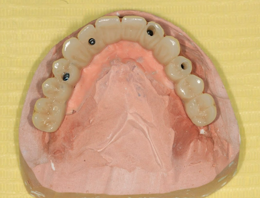 Occlusal view of the final screw-retained prosthesis showing the screw access channels.