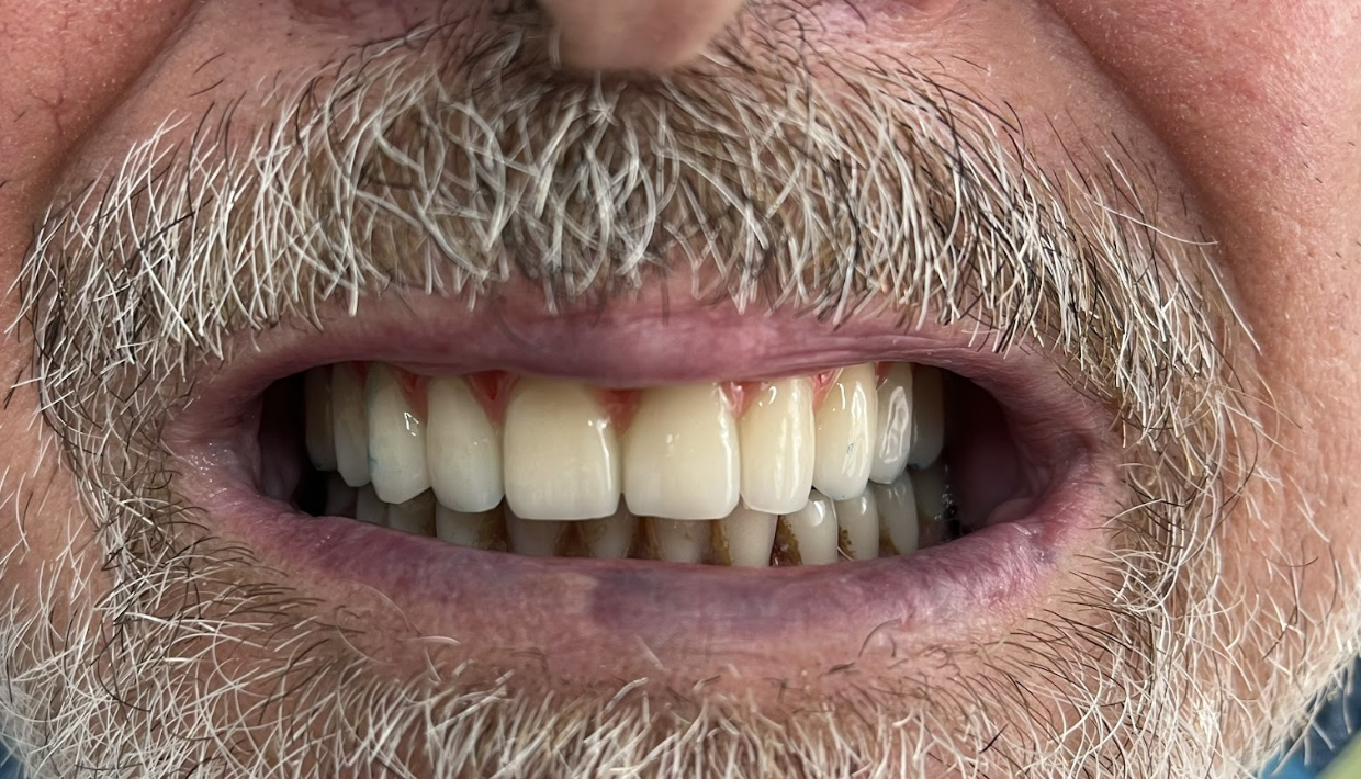 Final try-in of the tooth setup, compared with a digital scan for accuracy.