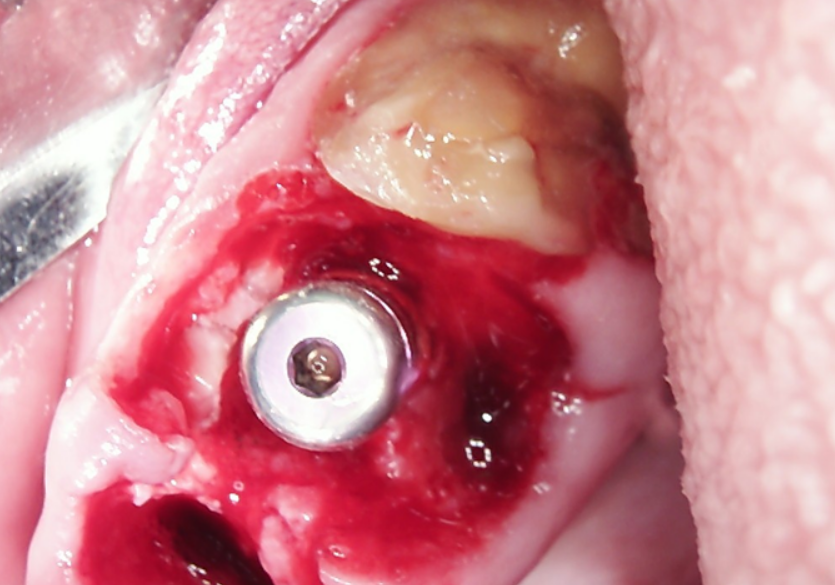 Close-up of immediate dental implant placement subcrestally into a fresh extraction socket.