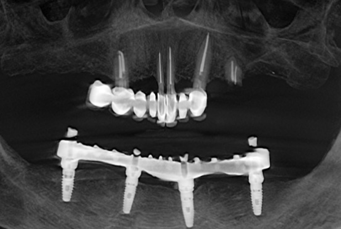 Initial CBCT scan showing non-restorable upper roots and the patient's existing lower bar-retained denture.