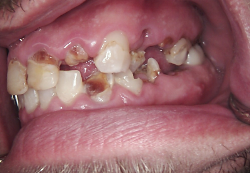 Patient's initial dental condition showing severe decay and missing teeth in the maxilla and mandible.