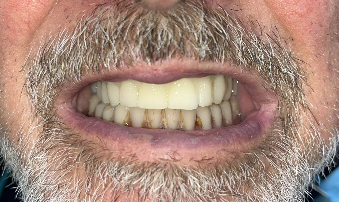 Initial prosthetic try-in to assess tooth morphology and occlusion.