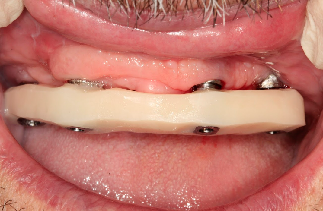Intraoral verification of the passive fit of the resin jig on all four XGATE multi-unit abutments.