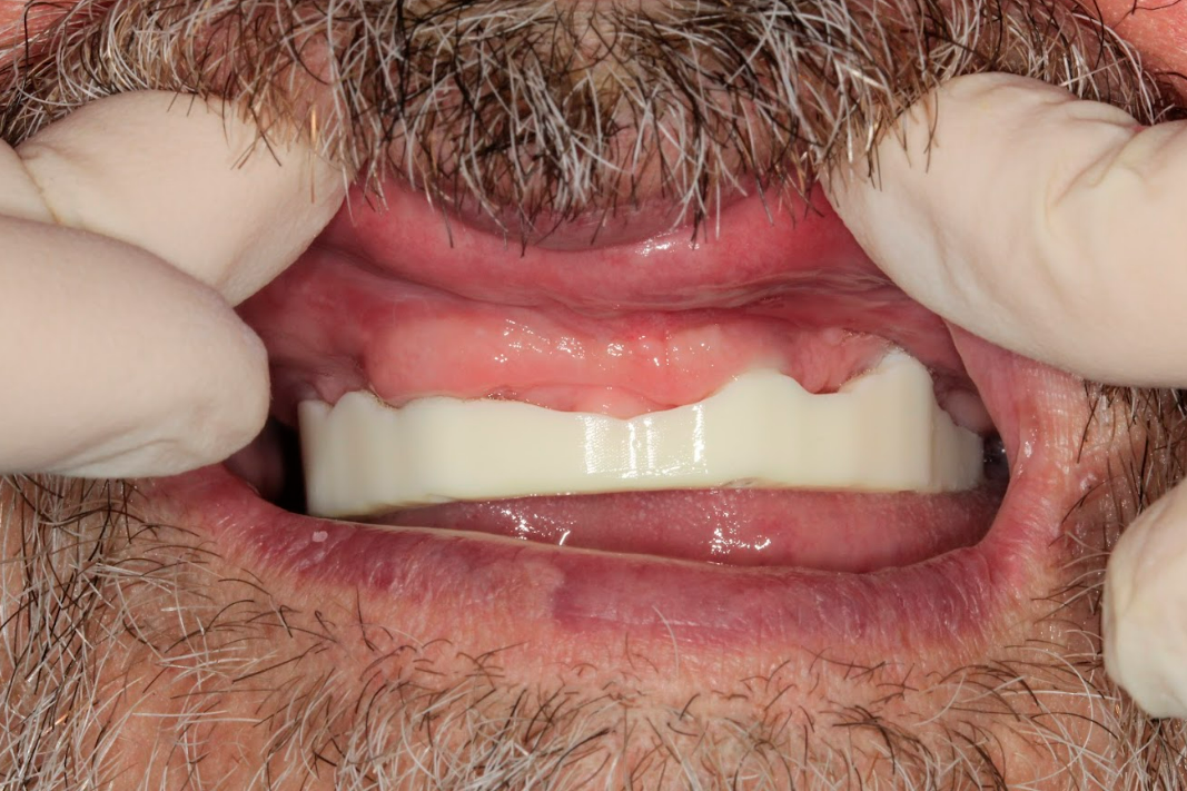 Intraoral try-in of the resin verification jig to check for a passive fit on the XGATE MUAs.