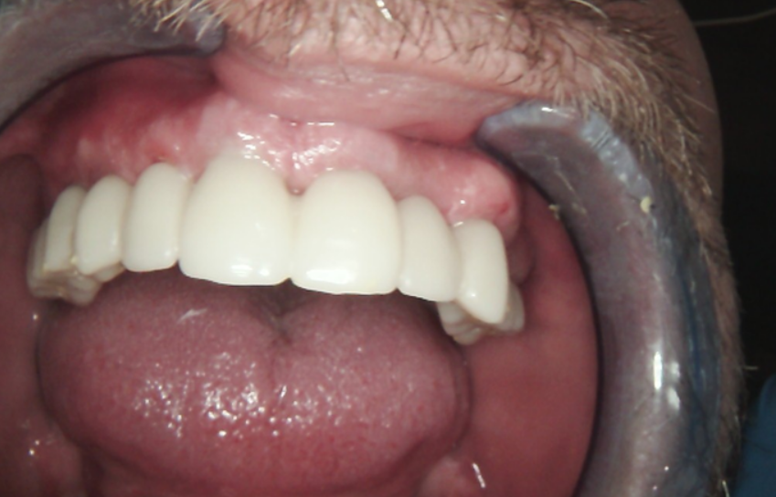 Clinical fit of the long-term milled PMMA provisional prosthesis on the multi-unit abutments.