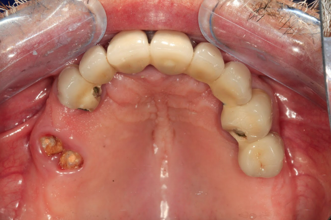 Occlusal view of the maxilla showing non-restorable natural tooth roots before extraction.