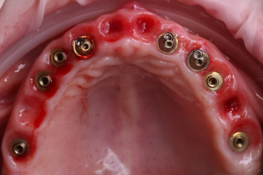Occlusal view of the maxillary arch after placement of 8 dental implants and XGATE D-Type and V-Type multi-unit abutments.