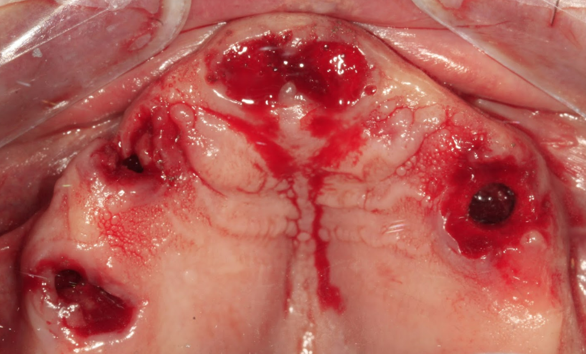 Maxillary arch immediately after the extraction of all non-restorable tooth roots.