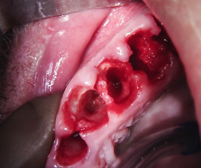 Post-extraction sockets in the maxilla before immediate implant placement using the root shield technique.