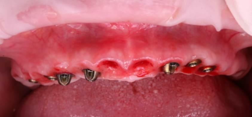 Frontal view of 8 dental implants in the maxilla, fitted with XGATE D-Type and V-Type multi-unit abutments.