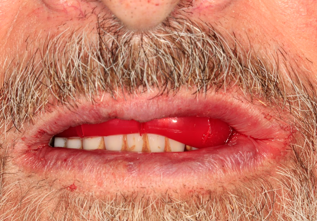 Patient's bite registered using a wax rim to record the vertical dimension of occlusion.