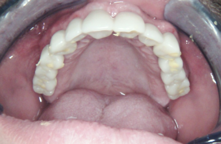 Occlusal view of the full-arch PMMA provisional bridge showing screw access channels.
