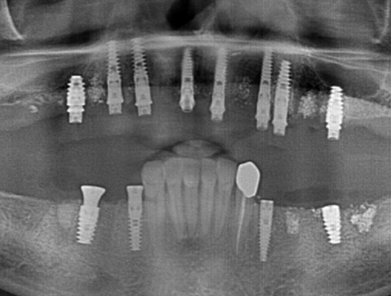 Panoramic radiograph showing eight implants in the maxilla and four in the mandible, with bone grafting visible.