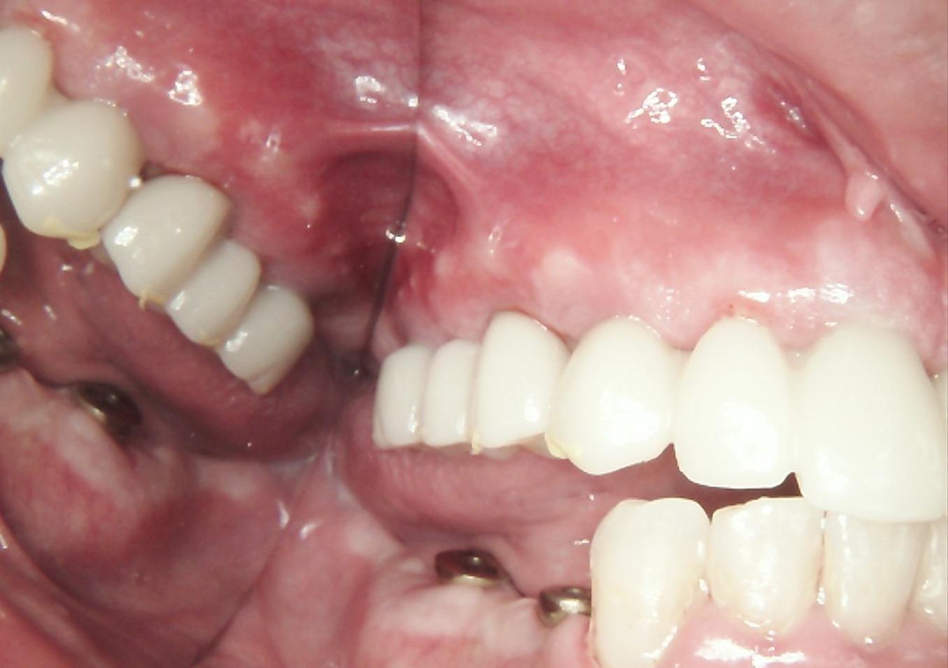 Provisional PMMA bridge restoration in the posterior mandible, restoring function and occlusion.